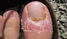 Traitement de la mycose des ongles