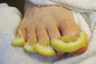 Citron mycose des ongles