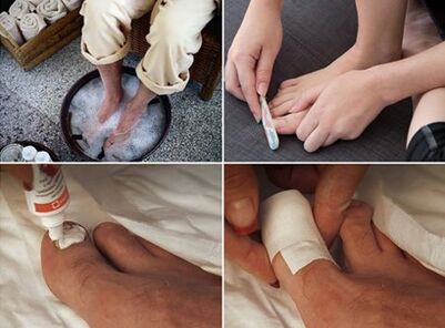 Apaiser les pieds et appliquer une crème à l'urée sur les ongles atteints de champignons