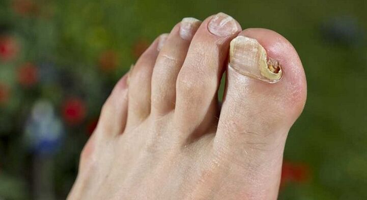 Dommages à la plaque à ongles avec des champignons sur les jambes