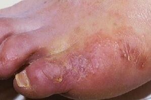 Manifestations d'une infection fongique sur la peau des jambes