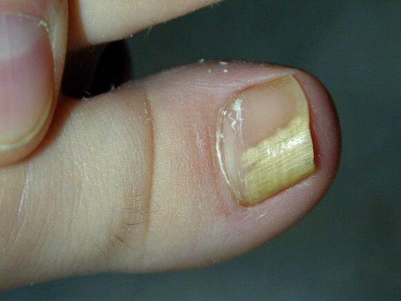 Infection fongique des ongles