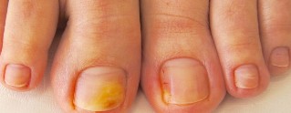 mycose des ongles des symptômes