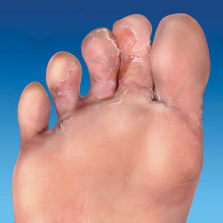 la peau mycose des pieds